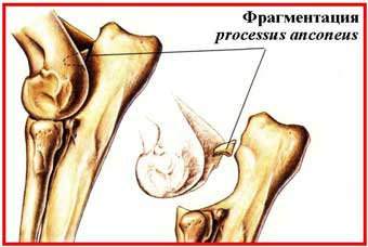 Рис. 18. Рентгенограммы. Склероз субхондральной костной пластинки, фрагментация pr. anconeus, деформирующий артроз.